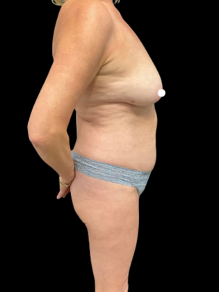 Mastopexy: Case 1 - Before