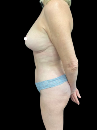 Mastopexy: Case 1 - After