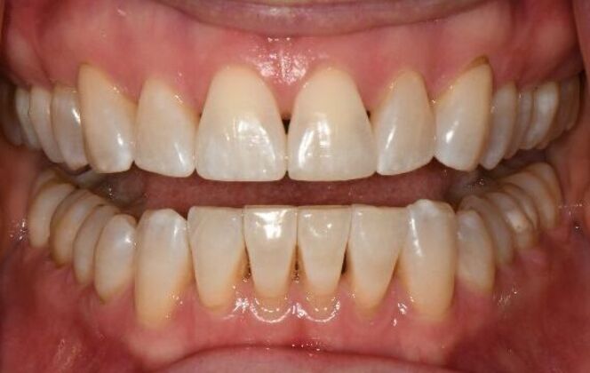 Cosmetic Bonding Cosmetic Bonding for a Youthful Smile - Before