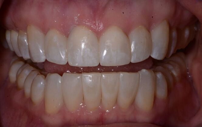 Cosmetic Bonding Cosmetic Bonding for a Youthful Smile - After