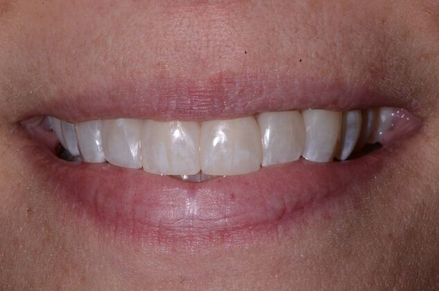 Cosmetic Bonding Case