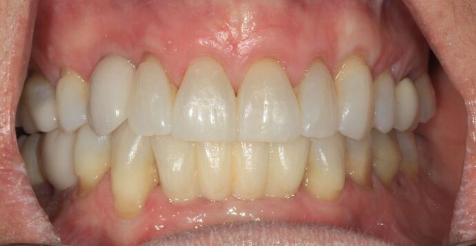 Dental Implants Case 19 - After