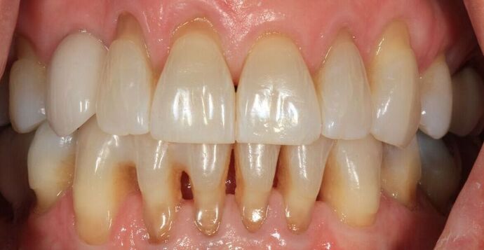 Dental Implants Case 19 - Before
