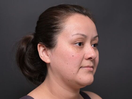 Facial Rejuvenation: FaceTite with Liposuction to Submental - Before