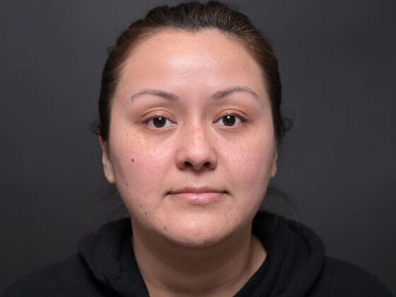 Facial Rejuvenation: FaceTite with Liposuction to Submental - Before