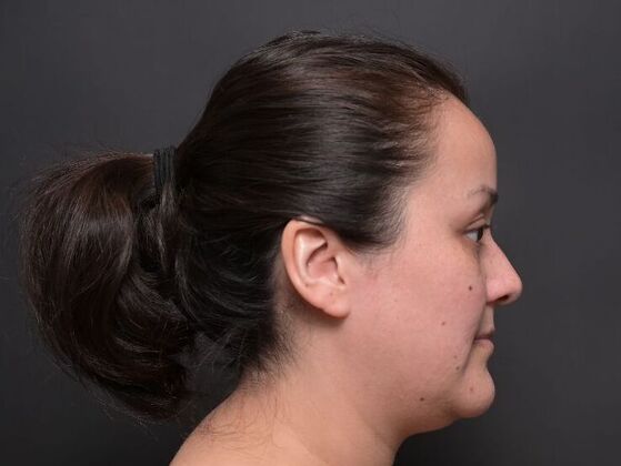 Facial Rejuvenation: FaceTite with Liposuction to Submental - Before