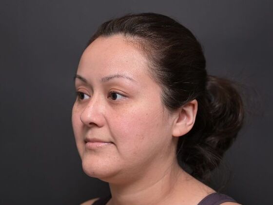 Facial Rejuvenation: FaceTite with Liposuction to Submental - Before