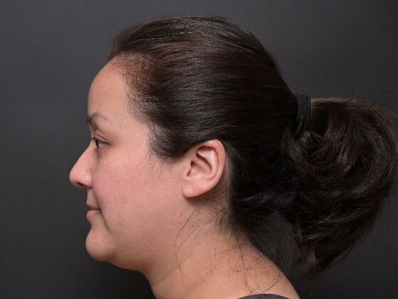 Facial Rejuvenation FaceTite with Liposuction to Submental - Before