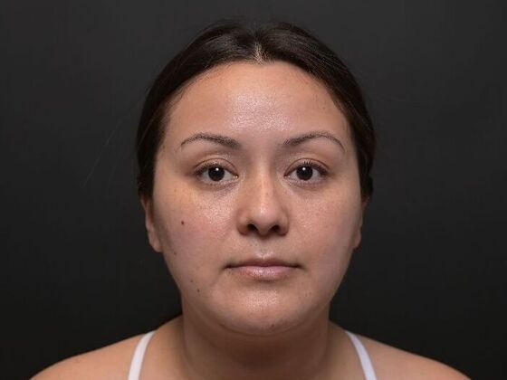 Facial Rejuvenation: FaceTite with Liposuction to Submental - After