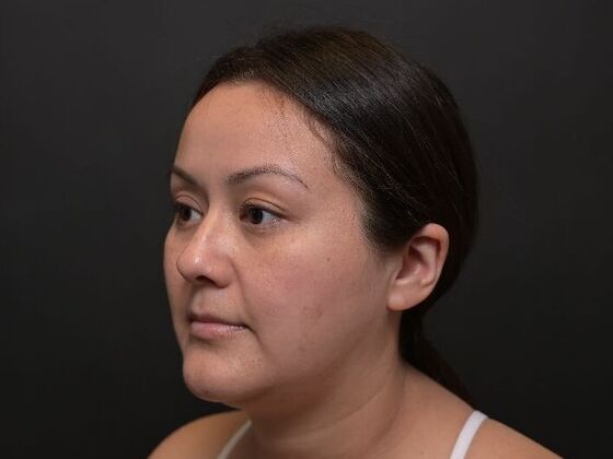Facial Rejuvenation: FaceTite with Liposuction to Submental - After
