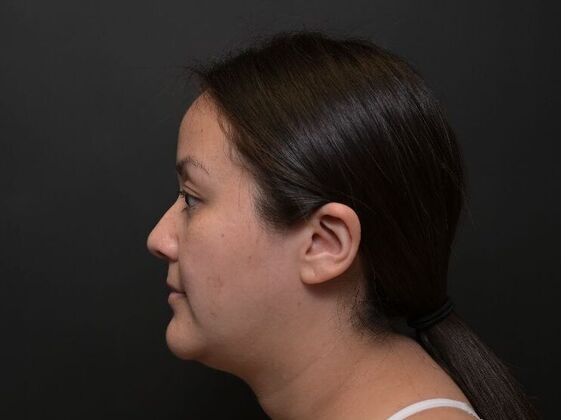 Facial Rejuvenation FaceTite with Liposuction to Submental - After