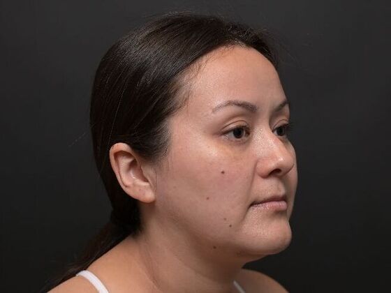 Facial Rejuvenation: FaceTite with Liposuction to Submental - After