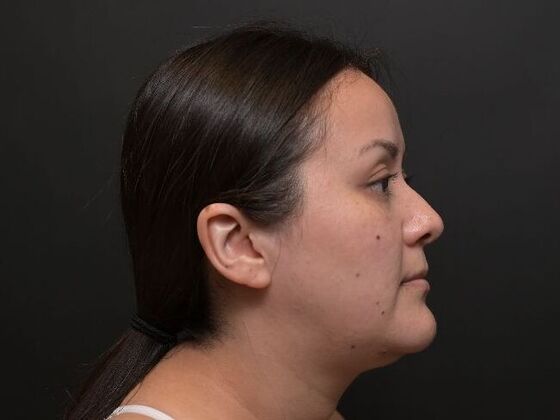 Facial Rejuvenation: FaceTite with Liposuction to Submental - After