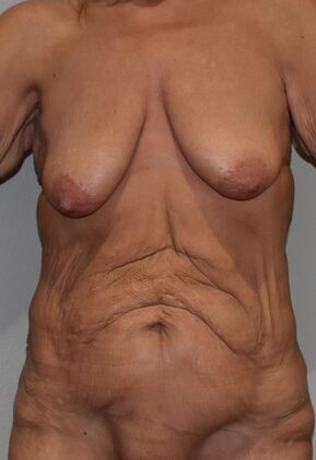 Massive Weight Loss  Case 227 - Before