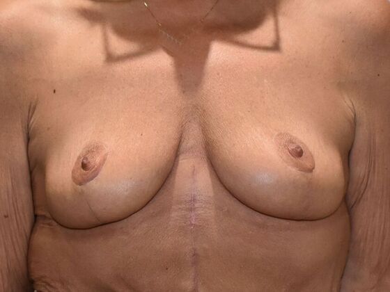 Breast Lift (Mastopexy) Case 281 - After