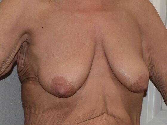 Breast Lift (Mastopexy): Case 281 - Before