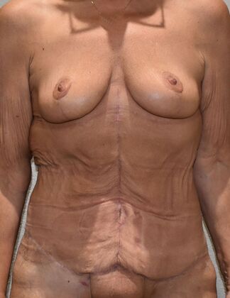 Mommy Makeover Case 391 - After