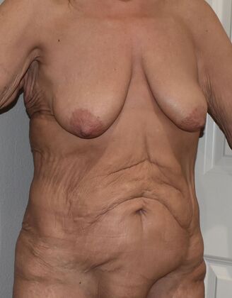 Mommy Makeover: Case 391 - Before
