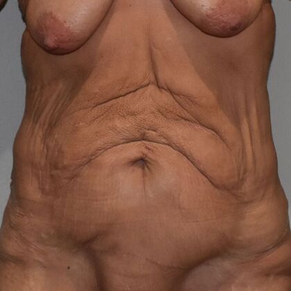 Tummy Tuck (Abdominoplasty) Case 607 - Before