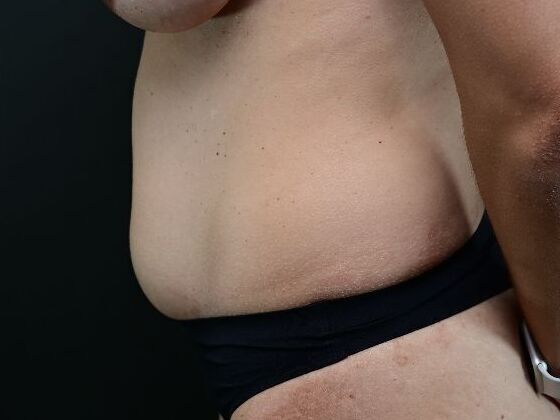 Liposuction and Lipocontouring: Case 2 - Before