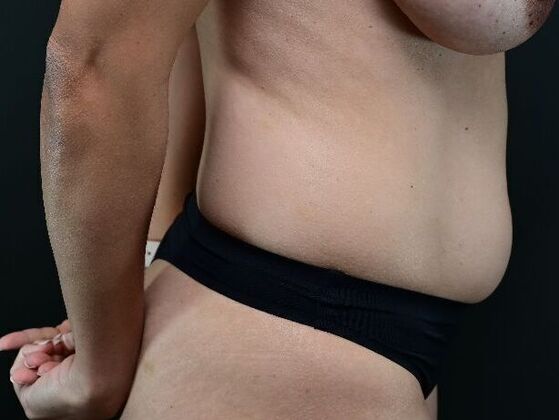 Liposuction and Lipocontouring: Case 2 - Before