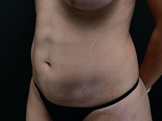 Liposuction and Lipocontouring Case 2 - After