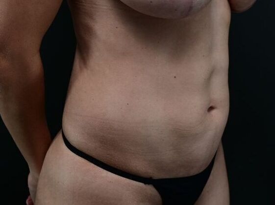 Liposuction and Lipocontouring: Case 2 - After
