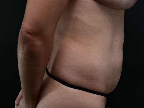 Liposuction and Lipocontouring: Case 2 - After