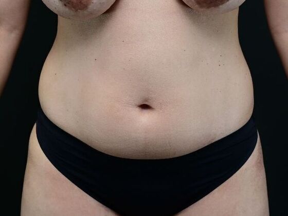 Liposuction and Lipocontouring: Case 2 - Before
