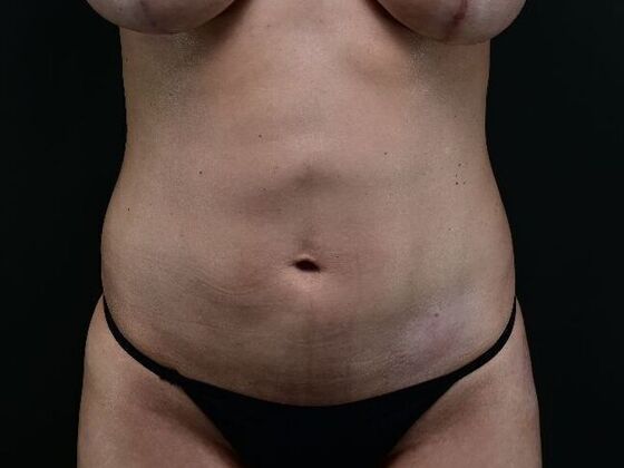 Liposuction and Lipocontouring: Case 2 - After