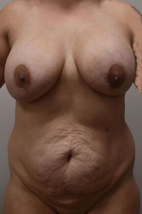 Mommy Makeover Case 392 - Before