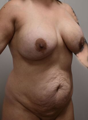 Mommy Makeover: Case 392 - Before