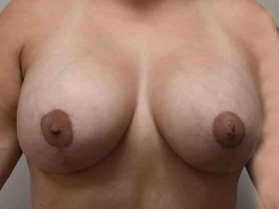 Breast Revision Case 357 - After