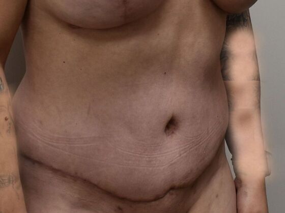 Tummy Tuck (Abdominoplasty): Case 608 - After