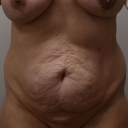 Tummy Tuck (Abdominoplasty) Case 608 - Before