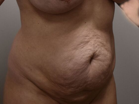 Tummy Tuck (Abdominoplasty): Case 608 - Before