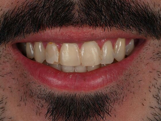 Dental Bonding Case 1 - Before