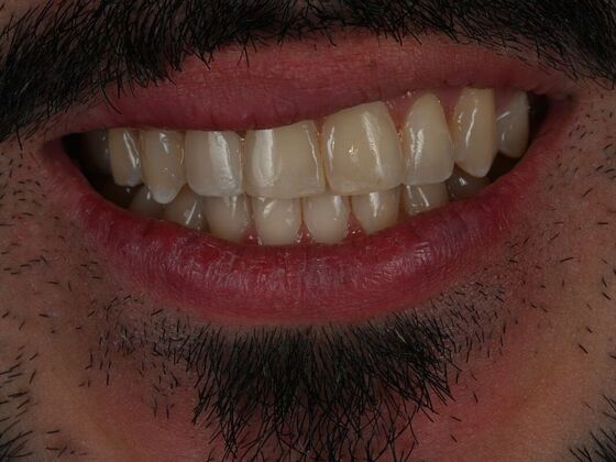 Dental Bonding Case 1 - After