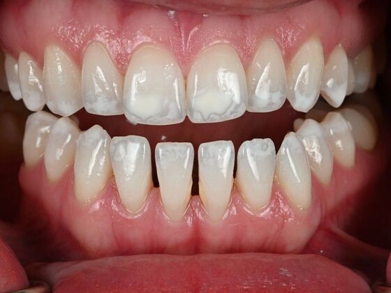 Dental Bonding Case 2 - Before