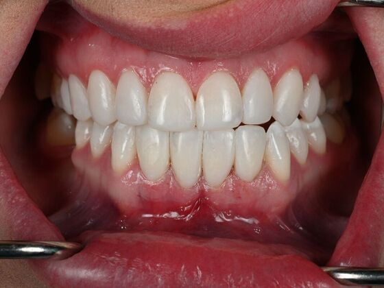 Dental Bonding Case 2 - After