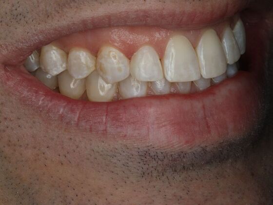 Dental Bonding Case 3 - After