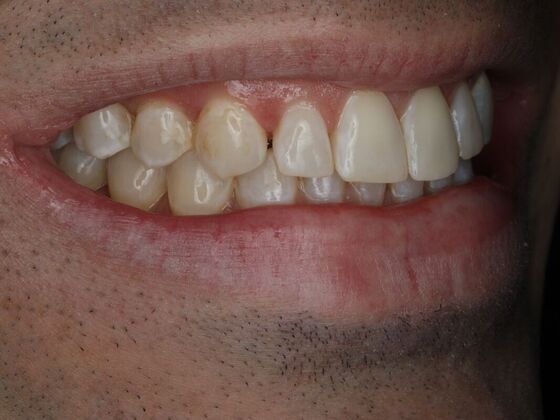Dental Bonding Case 3 - Before