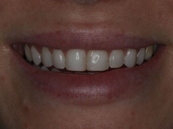 Dental Bonding Case 4 - Before
