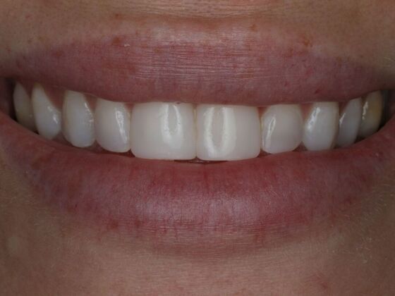 Dental Bonding Case 4 - After