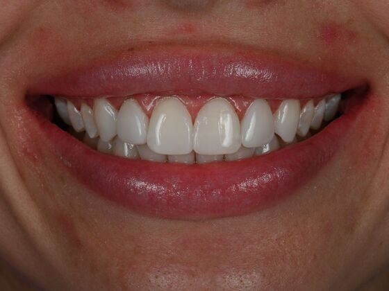 Dental Bonding Case 5 - After