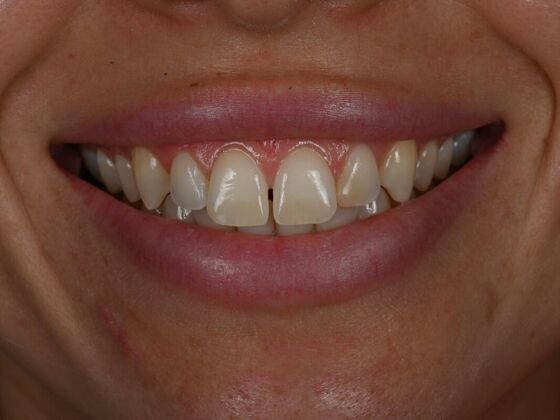 Dental Bonding Case 5 - Before