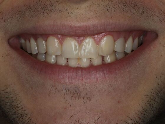 Dental Bonding Case 6 - After