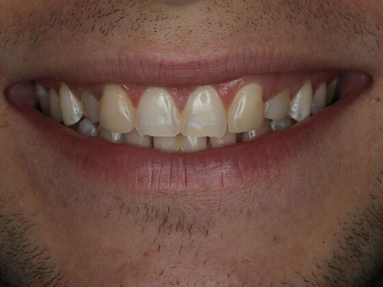 Dental Bonding Case 6 - Before