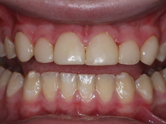 Dental Bonding Case 7 - After