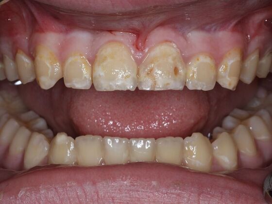 Dental Bonding Case 7 - Before
